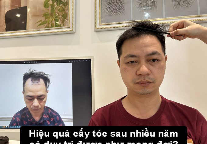 Hiệu quả của cấy tóc sau nhiều năm: Liệu có duy trì được như mong đợi?