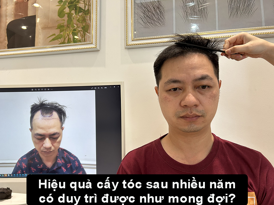 Hiệu quả của cấy tóc sau nhiều năm: Liệu có duy trì được như mong đợi?