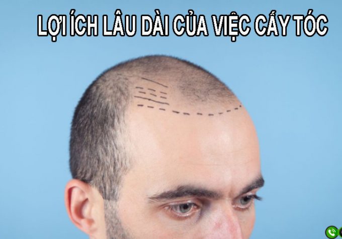 Lợi ích lâu dài của việc cấy tóc và ảnh hưởng tích cực tới ngoại hình