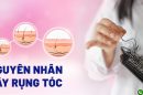 Tổng hợp các nguyên nhân tóc rụng và cách điều trị
