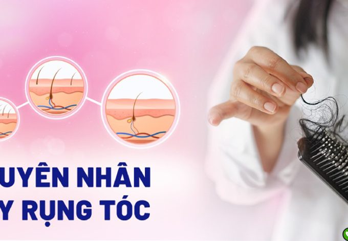 Tổng hợp các nguyên nhân tóc rụng và cách điều trị