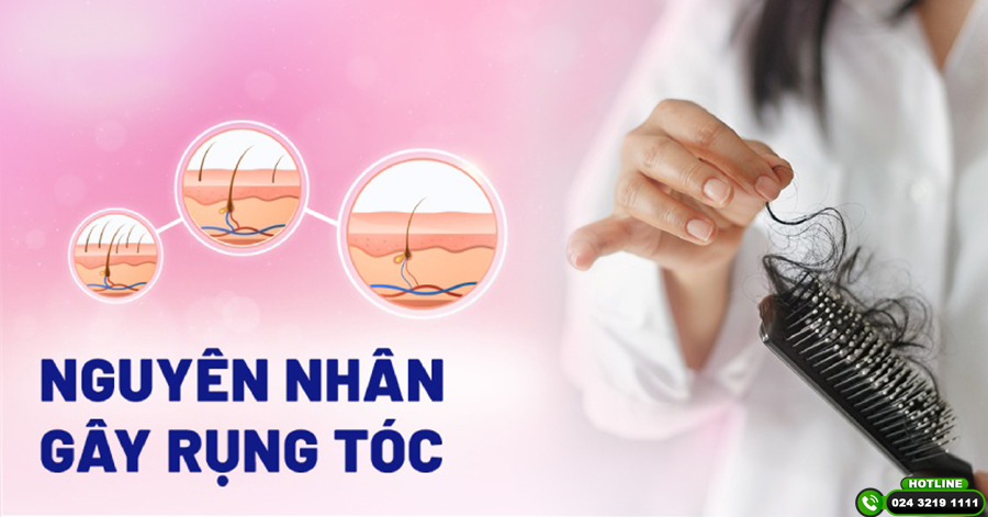 Tổng hợp các nguyên nhân tóc rụng và cách điều trị