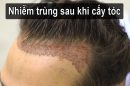 Nhiễm trùng sau khi cấy tóc: Dấu hiệu nhận biết và cách xử lý