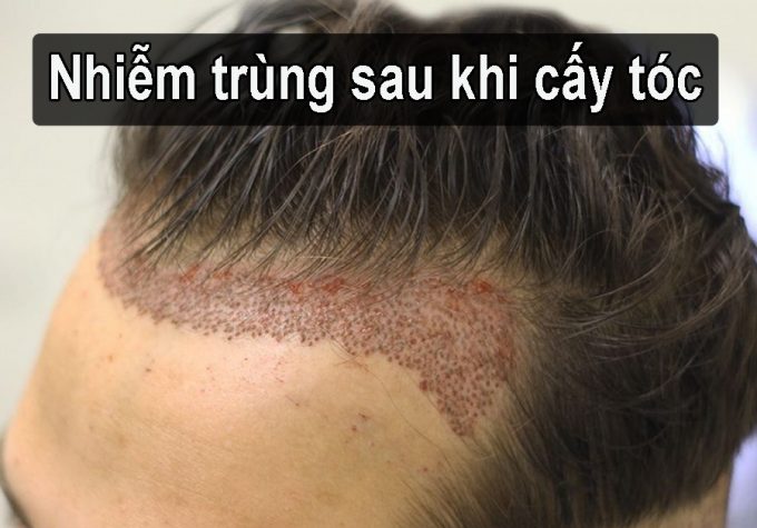 Nhiễm trùng sau khi cấy tóc: Dấu hiệu nhận biết và cách xử lý