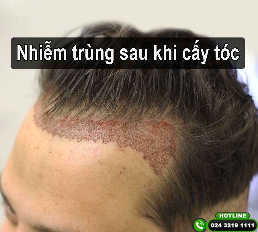 Nhiễm trùng sau khi cấy tóc: Dấu hiệu nhận biết và cách xử lý