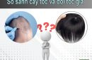 So sánh cấy tóc và đội tóc giả? Giải pháp nào ưu việt hơn?