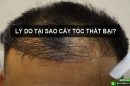 Tìm hiểu lý do tại sao cấy tóc thất bại