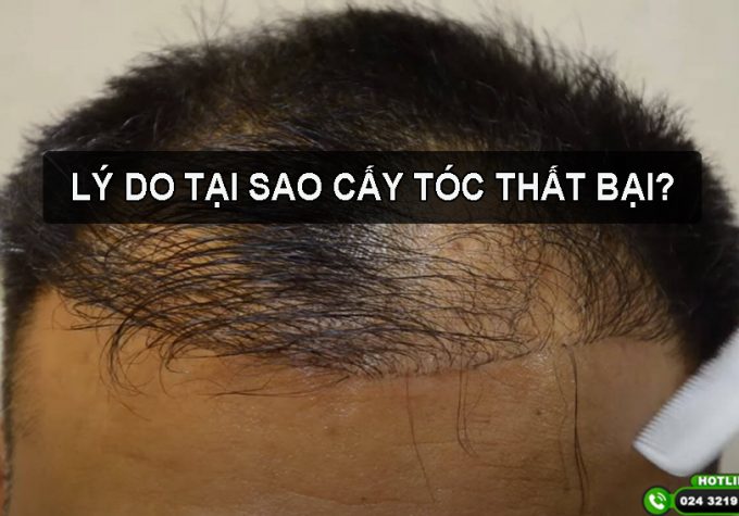 Tìm hiểu lý do tại sao cấy tóc thất bại
