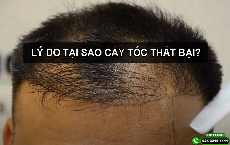 Tìm hiểu lý do tại sao cấy tóc thất bại