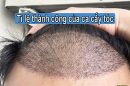 Tỷ lệ thành công của ca cấy tóc là bao nhiêu?