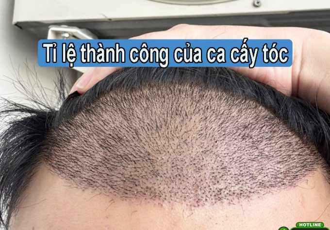 Tỷ lệ thành công của ca cấy tóc là bao nhiêu?