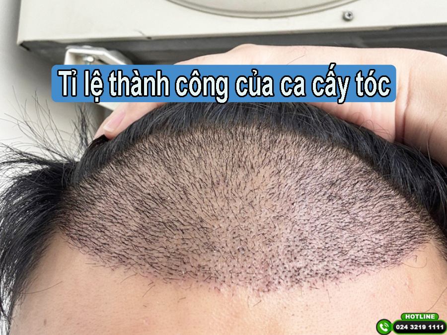 Tỷ lệ thành công của ca cấy tóc là bao nhiêu?