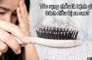 Tóc rụng nhiều là bệnh gì? Điều trị như thế nào?