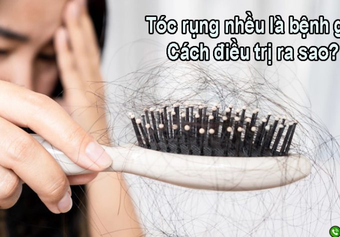 Tóc rụng nhiều là bệnh gì? Điều trị như thế nào?