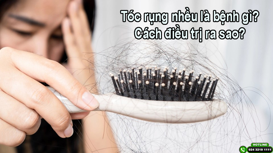 Tóc rụng nhiều là bệnh gì? Điều trị như thế nào?