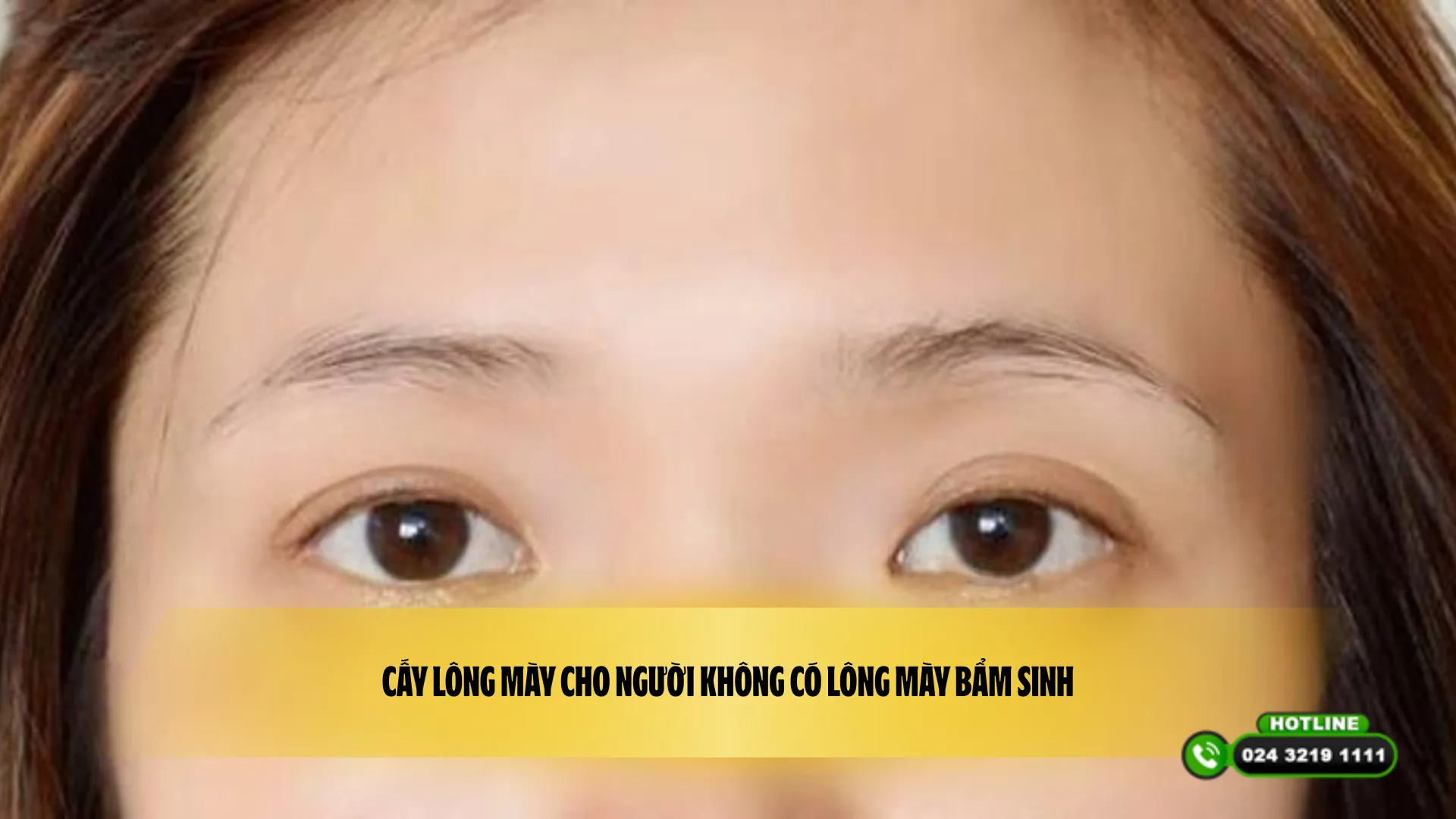 Cấy lông mày cho người không có lông mày bẩm sinh