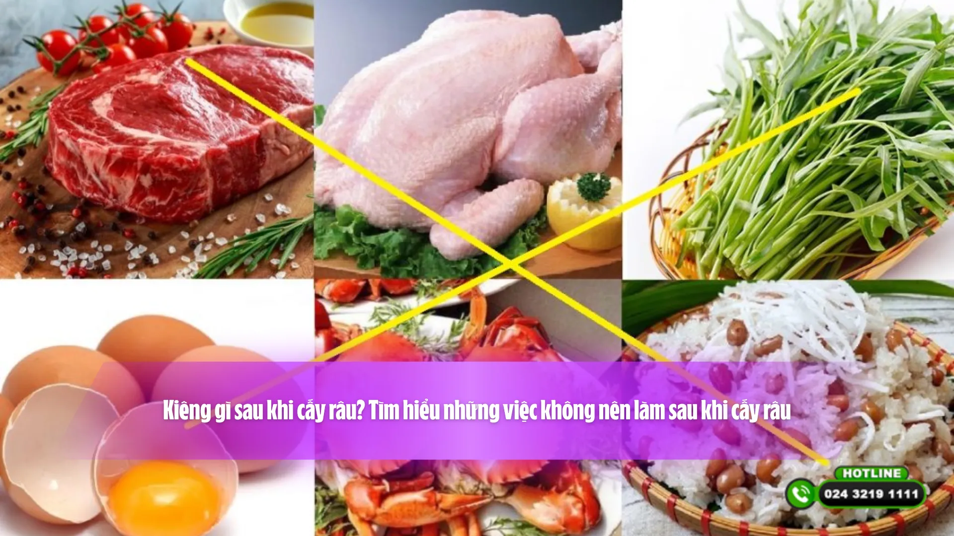 Kiêng gì sau khi cấy râu? Tìm hiểu những việc không nên làm sau khi cấy râu