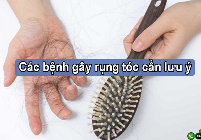 Các bệnh gây rụng tóc cần chú ý và điều trị ngay