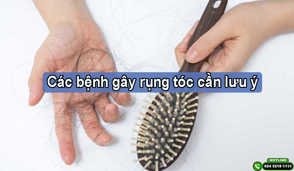 Các bệnh gây rụng tóc cần chú ý và điều trị ngay