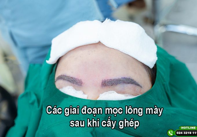 Tìm hiểu các giai đoạn mọc lông mày sau cấy ghép