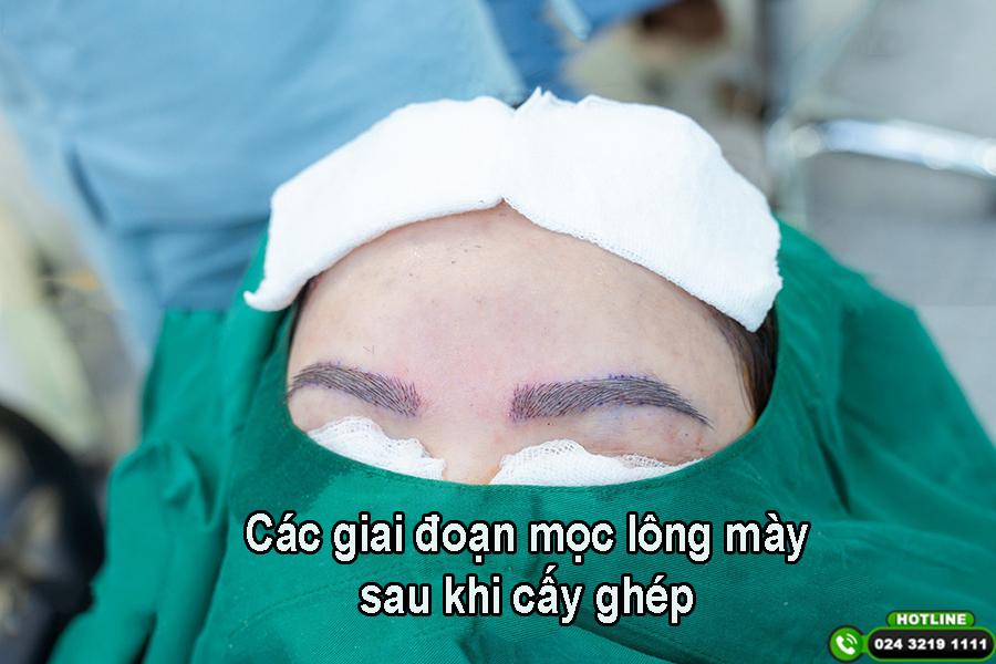Tìm hiểu các giai đoạn mọc lông mày sau cấy ghép