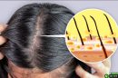 6 cách trị gàu đơn giản tại nhà có thể áp dụng ngay
