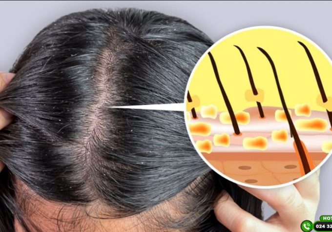 6 cách trị gàu đơn giản tại nhà có thể áp dụng ngay