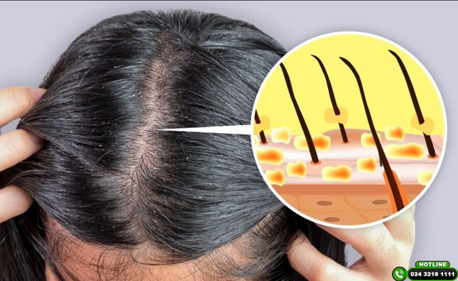 6 cách trị gàu đơn giản tại nhà có thể áp dụng ngay