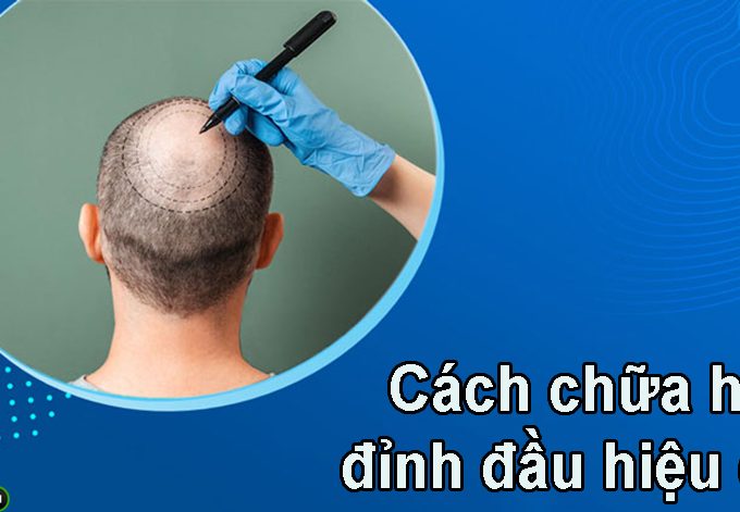 Cấy tóc tự thân – Cách trị hói đỉnh đầu hiệu quả
