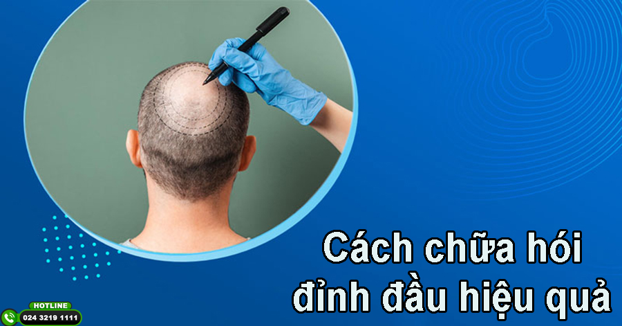 Cấy tóc tự thân – Cách trị hói đỉnh đầu hiệu quả