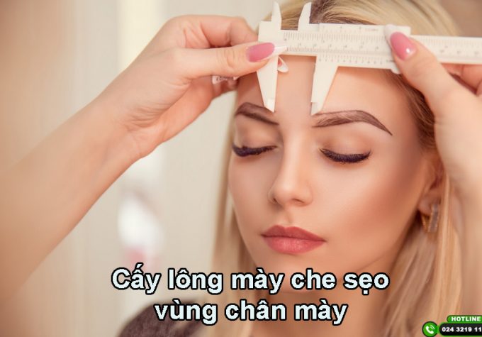 Cấy lông mày che sẹo vùng chân mày: Giải pháp thẩm mỹ an toàn, hiệu quả lâu dài