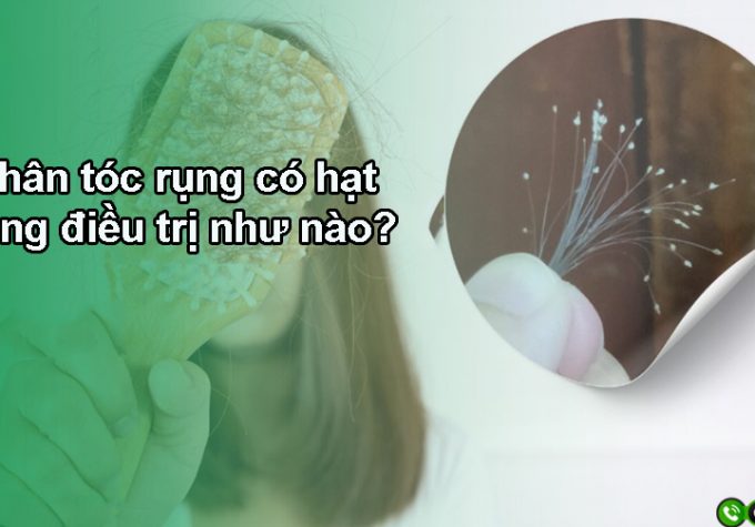 Chân tóc rụng có hạt trắng điều trị như thế nào?