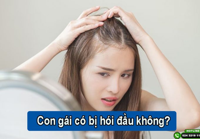 Con gái có bị hói đầu không? Cách phòng tránh và khắc phục hiệu quả