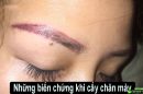 Cảnh báo những biến chứng khi cấy chân mày do chọn sai địa chỉ thẩm mỹ