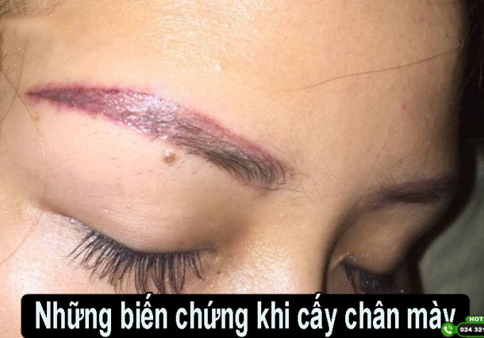 Cảnh báo những biến chứng khi cấy chân mày do chọn sai địa chỉ thẩm mỹ