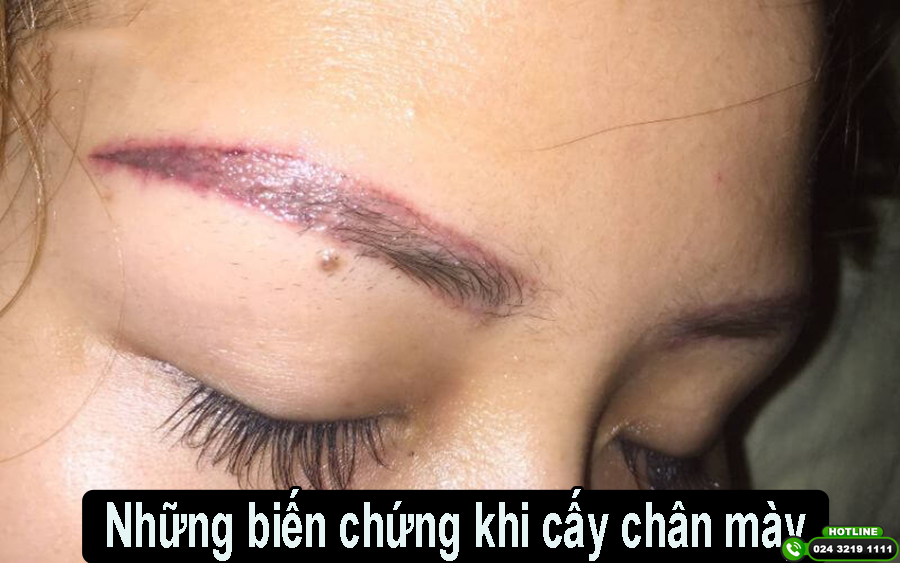 Cảnh báo những biến chứng khi cấy chân mày do chọn sai địa chỉ thẩm mỹ