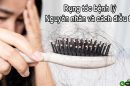 Rụng tóc bệnh lý: Nguyên nhân và cách điều trị