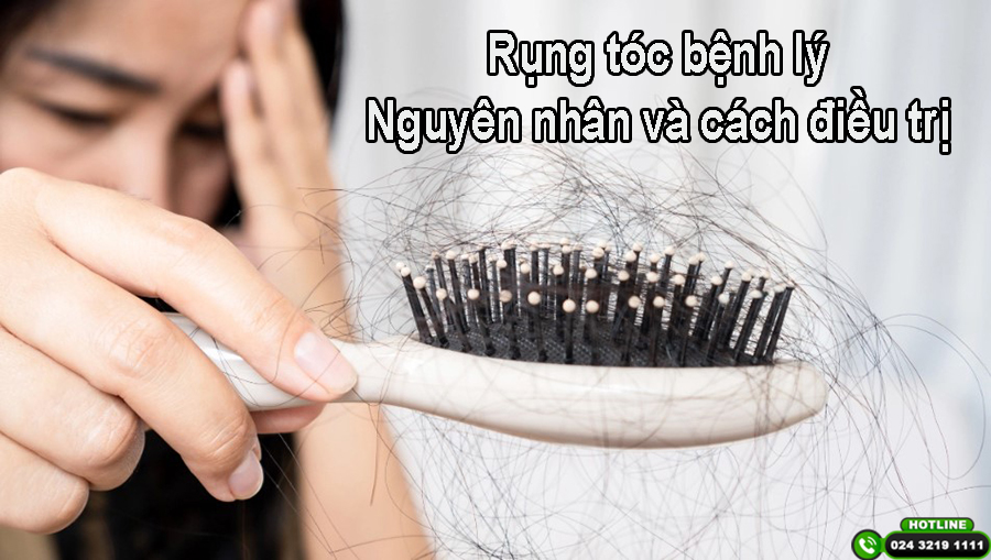 Rụng tóc bệnh lý: Nguyên nhân và cách điều trị