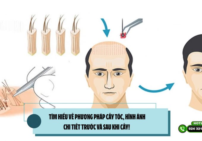 TÌM HIỂU VỀ PHƯƠNG PHÁP CẤY TÓC, HÌNH ẢNH CHI TIẾT TRƯỚC VÀ SAU KHI CẤY! 
