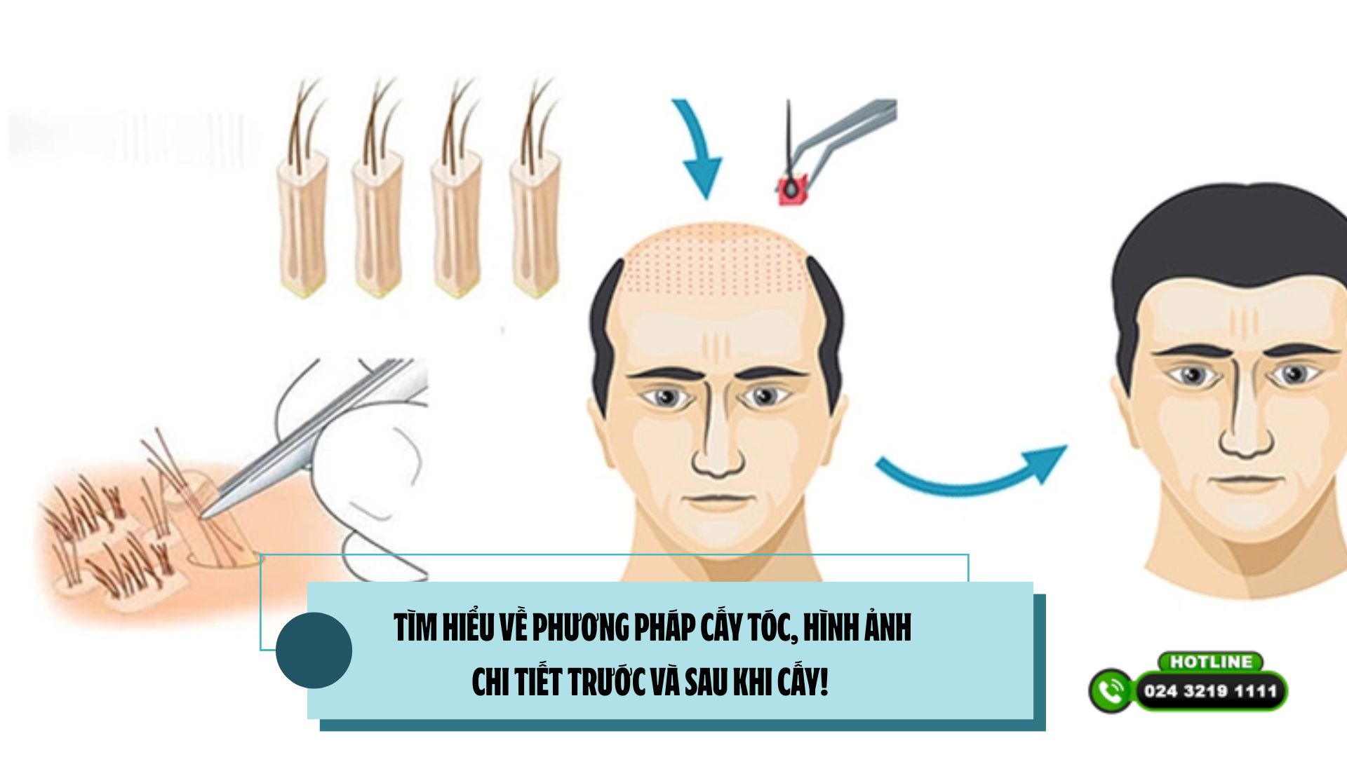 TÌM HIỂU VỀ PHƯƠNG PHÁP CẤY TÓC, HÌNH ẢNH CHI TIẾT TRƯỚC VÀ SAU KHI CẤY! 