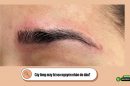 Cấy lông mày bị sẹo nguyên nhân do đâu?