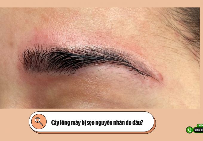 Cấy lông mày bị sẹo nguyên nhân do đâu?