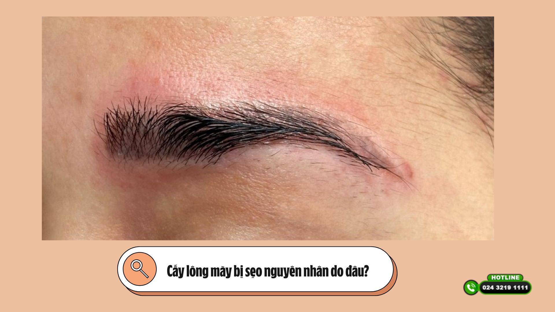 Cấy lông mày bị sẹo nguyên nhân do đâu?