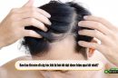 Bao lâu thì nên đi cấy tóc khi bị hói để đạt được hiệu quả tốt nhất?
