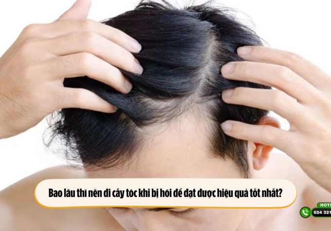 Bao lâu thì nên đi cấy tóc khi bị hói để đạt được hiệu quả tốt nhất?