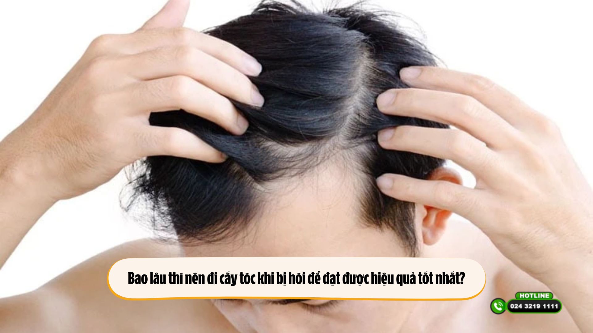 Bao lâu thì nên đi cấy tóc khi bị hói để đạt được hiệu quả tốt nhất?