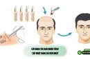 Cấy nang tóc bao nhiêu tiền? Cập nhật bảng giá mới nhất