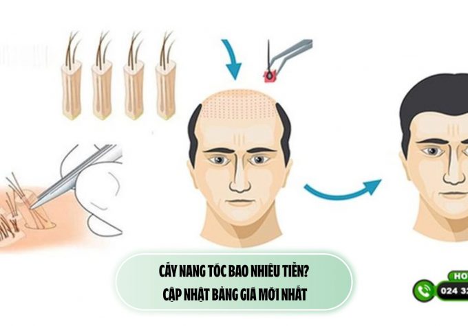 Cấy nang tóc bao nhiêu tiền? Cập nhật bảng giá mới nhất