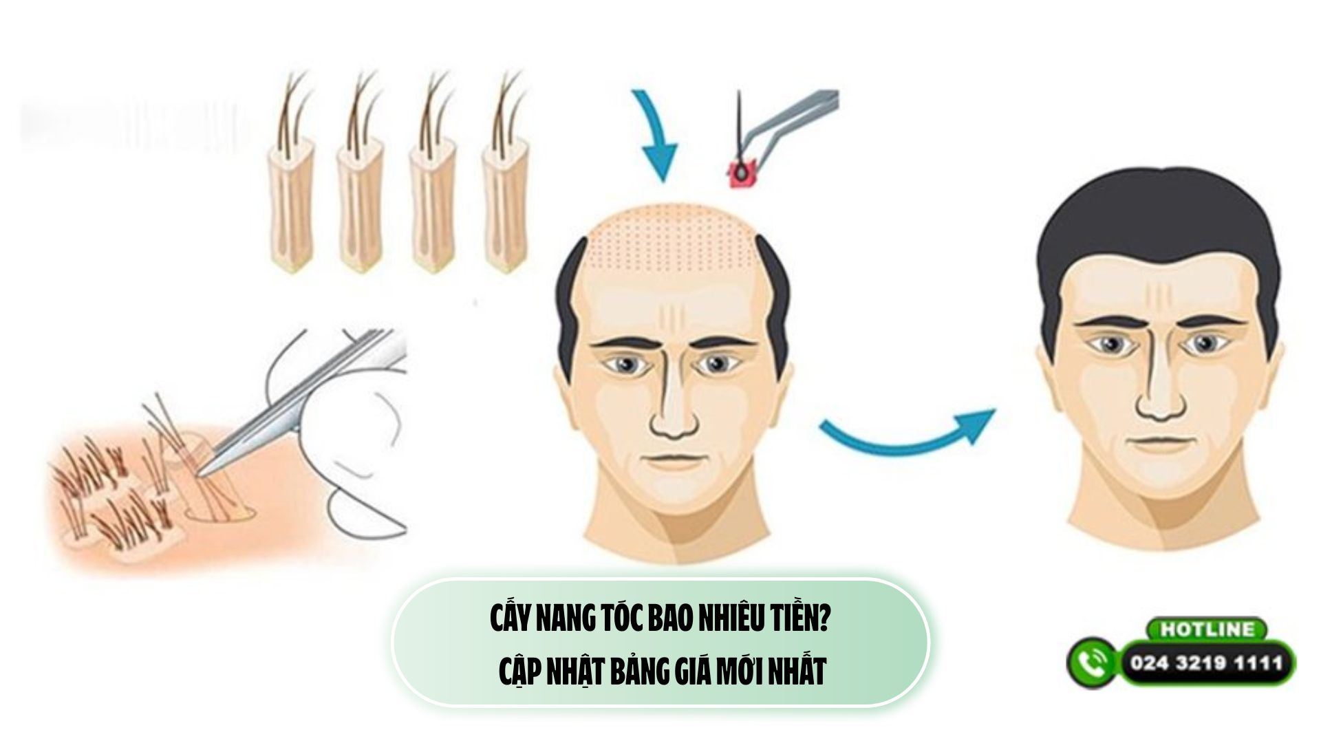 Cấy nang tóc bao nhiêu tiền? Cập nhật bảng giá mới nhất