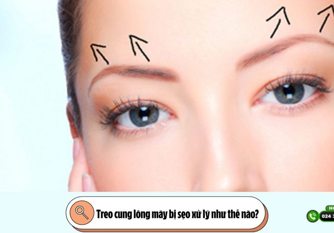 Treo cung lông mày bị sẹo xử lý như thế nào?